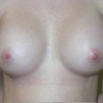 Breast Augmentation Before & After Patient #81
