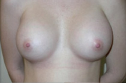 Breast Augmentation Before & After Patient #81