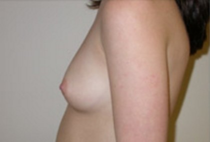 Breast Augmentation Before & After Patient #81