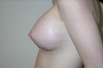 Breast Augmentation Before & After Patient #81
