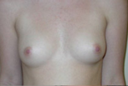 Breast Augmentation Before & After Patient #81