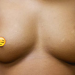 Breast Augmentation Before & After Patient #366