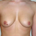 Breast Augmentation Before & After Patient #375