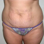 Abdominoplasty Before & After Patient #941