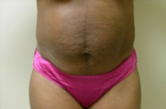 Abdominoplasty Before & After Patient #942