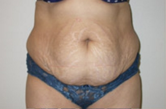 Abdominoplasty Before & After Patient #945