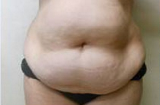 Abdominoplasty Before & After Patient #946