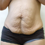 Abdominoplasty Before & After Patient #948