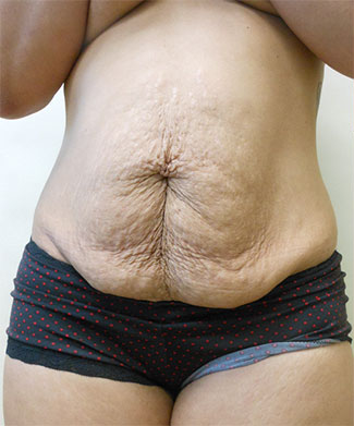 Abdominoplasty Before & After Patient #948