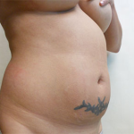 Abdominoplasty Before & After Patient #951