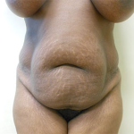 Abdominoplasty Before & After Patient #985