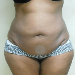 Abdominoplasty Before & After Patient #987