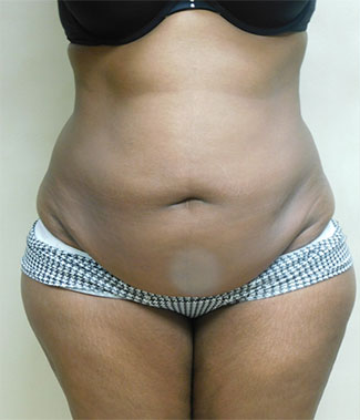 Abdominoplasty Before & After Patient #987