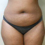 Abdominoplasty Before & After Patient #989