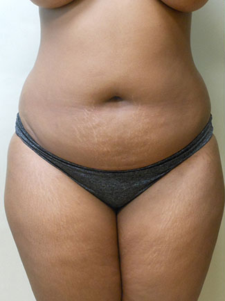 Abdominoplasty Before & After Patient #989