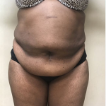 Abdominoplasty Before & After Patient #990