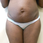 Abdominoplasty Before & After Patient #994