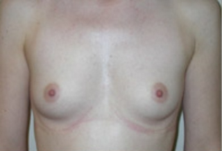 Breast Augmentation Before & After Patient #421