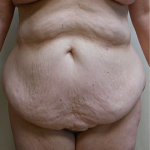 Abdominoplasty Before & After Patient #995