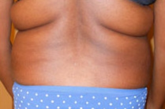 Liposuction Before & After Patient #1021