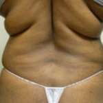 Liposuction Before & After Patient #1022