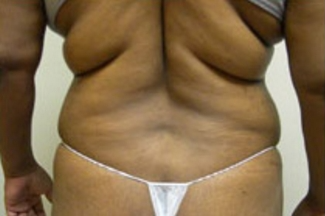 Liposuction Before & After Patient #1022