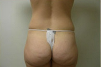 Liposuction Before & After Patient #1024