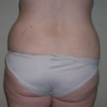 Liposuction Before & After Patient #1029