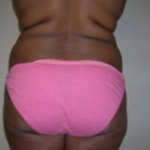 Liposuction Before & After Patient #1055