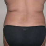 Liposuction Before & After Patient #1056
