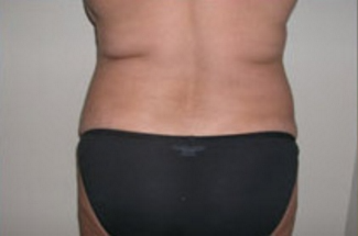 Liposuction Before & After Patient #1056