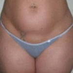 Liposuction Before & After Patient #1058