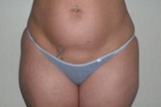 Liposuction Before & After Patient #1058