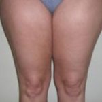 Liposuction Before & After Patient #1059