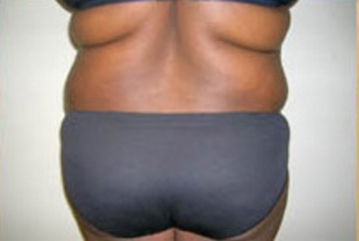 Liposuction Before & After Patient #1060