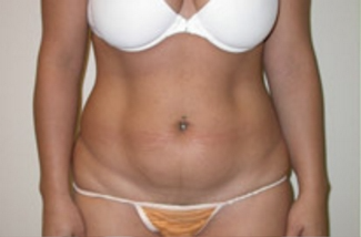 Liposuction Before & After Patient #1063