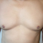 Liposuction Before & After Patient #1092