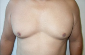 Liposuction Before & After Patient #1092