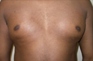Liposuction Before & After Patient #1093