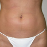 Liposuction Before & After Patient #1094