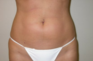 Liposuction Before & After Patient #1094