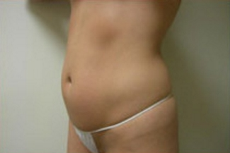 Liposuction Before & After Patient #1095