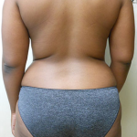 Liposuction Before & After Patient #1096