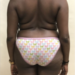 Liposuction Before & After Patient #1097