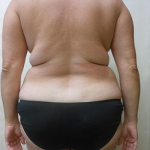 Liposuction Before & After Patient #1101