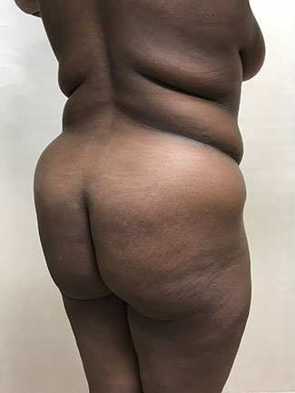 Brazilian Butt Lift Before & After Patient #1131