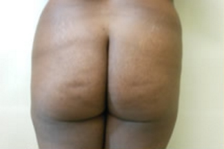 Brazilian Butt Lift Before & After Patient #1134