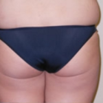 Brazilian Butt Lift Before & After Patient #1138