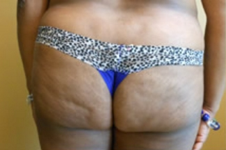 Brazilian Butt Lift Before & After Patient #1139