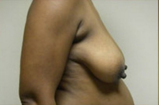 Breast Lift Before & After Patient #429